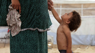 La varicela se propaga en los saturados campamentos de Gaza